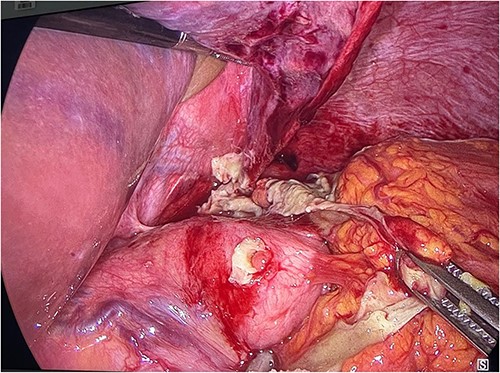 Laparoscopic visualization showing fibrinous strands at the level of the gastric fundus covering a fundal perforation.