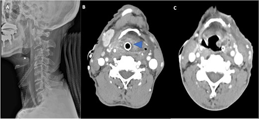 (A) Lateral radiograph of the neck shows a swollen epiglottis (*). (B) Computed tomography axial cut shows a collection in the paraglottic space (arrowhead) and parapharyngeal space extenuation with effaced pharyngeal and supraglottic lumina due to epiglottic enlargement. (C) Computed tomography axial cut at Day 7 post-operatively reveals a marked reduction in the size of the collection.