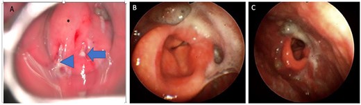 (A) Direct laryngoscopic examination shows a swollen epiglottis (*) with pus extruding at the level of the right and left aryepiglottic folds as indicated by arrowhead and arrow, respectively. (B) Transnasal laryngoscopic examination of the larynx at Day 7 post-operatively revealed a normal-shaped epiglottis (*) with a visible glottic airway during adduction and (C) abduction.