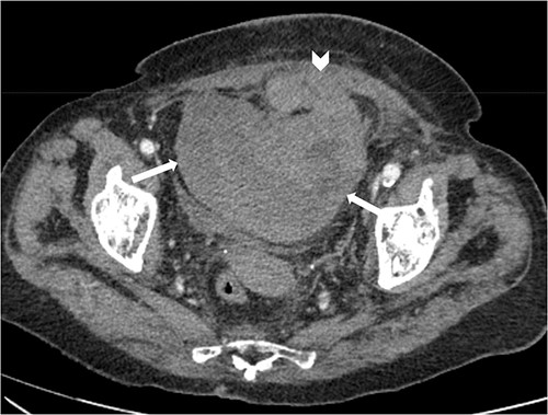 Axial non-contrast CT abdomen and pelvis at the level of acetabulum. Rectus sheath haematoma (chevron) that appears to have dissected through the rectus sheath into the extraperitoneal pelvic space (arrows).