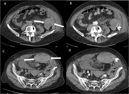 Axial non-contrast and post-contrast (100-s delay) CT abdomen and pelvis slices demonstrating two further left abdominal wall and pre-peritoneal collections (white arrows) with high attenuation on non-contrast slices (A and C) in keeping with haematoma. There is contrast blush in two locations (white chevrons in B and D) in keeping with active bleeding. The vascular territories that have likely contributed to bleeding include branches of left inferior epigastric and left lumbar arteries.
