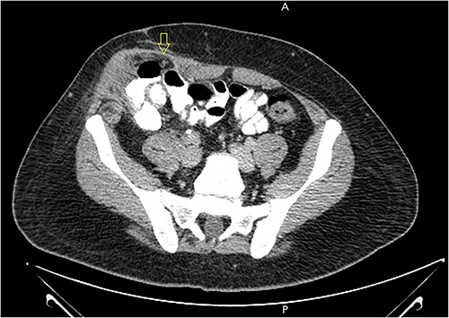 Abdomen CT scan with IV contrast demonstrated a large m peritoneal defect containing cecum and terminal ileum with an oval fatty density 1.5*2 cm represent an inflamed epiploic appendages (arrow) that have a hyper-attenuating rim and “central dot sign” with inflammatory changes in the adjacent fat tissue.