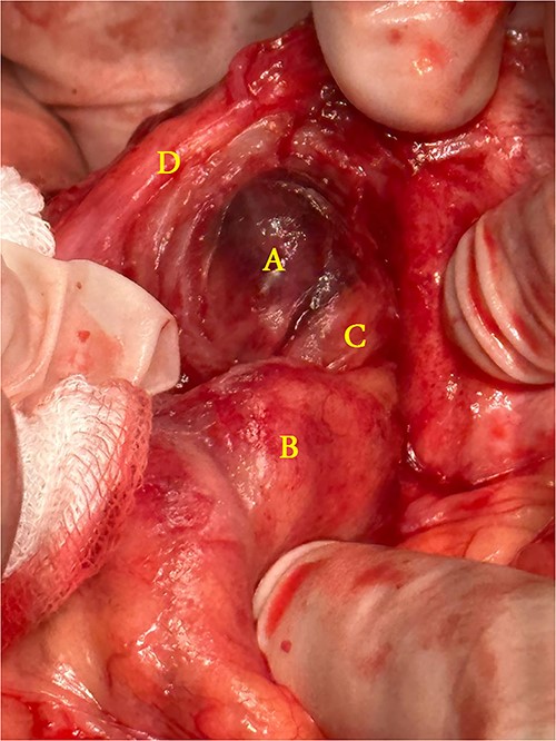 Operative findings: (A) infarcted epiploic appendages, (B) cecum, (C) ascending colon, (D) hernial sac.