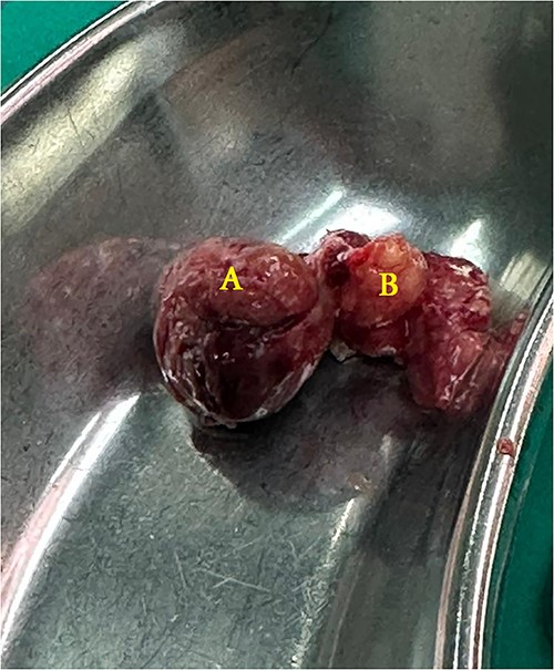 The removed specimen: edematous-infarcted epiploic appendage, measure 3*3 cm (A) and a free fatty body (B) found in the hernia sac.