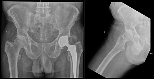 Preoperative AP pelvis and lateral right hip radiographs of our patient showing right hip osteoarthritis and previous left THR in situ.