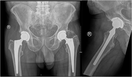 AP pelvis and lateral right hip radiographs 6 weeks post primary right THR when our patient presented with clinical signs of PJI. The implants were in a satisfactory position.