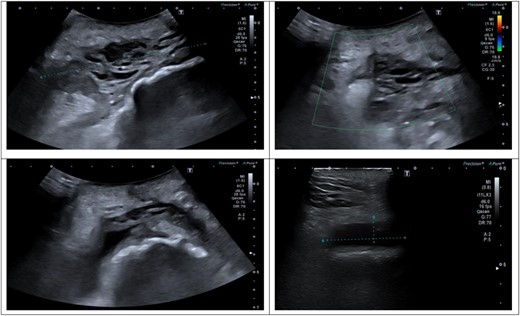 (A–D) Ultrasound scan of right hip and thigh showing a large 10.1 × 4.3 cm complex collection with mixed solid/cystic components. There was no internal vascularity. This was associated with a tract extending from the skin surface and a deeper fluid collection that tracked along the posterolateral right femoral shaft. There was significant oedema of the subcutaneous tissue overlying the hip and thigh.