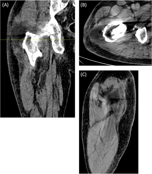 (A) Coronal, (B) Axial (C) Sagittal CT scan of right femur with contrast. The axial image is taken at the level marked on the coronal image. There is a large 8.3 cm × 4.5 cm × 4.5 cm collection seen adjacent to the greater trochanter with no evidence of fistulous communication with the joint. A separate locule of fluid 2.5 cm in size was seen superior to this and communicated with the main collection. There was no sign of prosthetic loosening or radiological evidence of osteomyelitis.