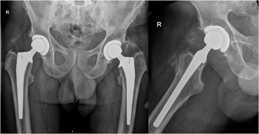 AP pelvis and lateral right hip radiographs at 6 months post debridement, antibiotics, implant retention (DAIR) procedure.