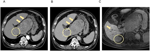 CT and MRI at the initial examination. Axial enhanced CT reveals mass lesions of 14 cm (A, B, arrow) and 3 cm (A, B, circle) in S1, with heterogenous enhancement in the arterial phase (A) and a washout pattern in the portal phase (B). Axial enhanced MRI shows the lesions in S1 and other lesions of 5 cm in S6/7 (C, circle) and 1 cm in S6 (C, arrow), which demonstrate decreased ethoxybenzyl uptake. S, segment.
