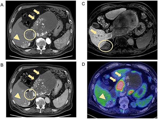 CT and MRI after LEN plus TACE. Axial enhanced CT shows weakened stained areas of the tumors in S1 (A, B, arrow, circle) and S6/7 with internal lipiodol deposition and poor enhancement (A, B, arrowhead), with weakly enhanced areas at the margins that are suspected to be viable lesions. MRI reveals lesions with extensive internal hemorrhage because of treatment in S6/7 (C, circle) and S6 (C, arrow). Positron emission tomography-CT shows the mass lesions with abnormal accumulation in liver S1 (SUV max 11.7; D, arrow) and S6/7 (SUV max 4.2; D, arrowhead). S, segment; SUV, standardized uptake value.
