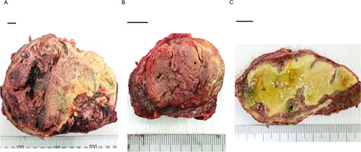 Photographs showing extensive necrosis and hemorrhage of the resected tumors after LEN and TACE. (A) One of the S1 tumors was a well to poorly differentiated HCC, of which 11% was viable tumor cells. (B) The other S1 tumor was a well to moderately differentiated HCC with 5% viable lesions. (C) The S6/7 tumor was a well to moderately differentiated HCC with 2% viable lesions. Scale bar = 10 mm. S, segment.