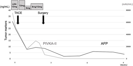 Treatment timeline with the pre- and postoperative serum AFP and PIVKA-II concentrations.