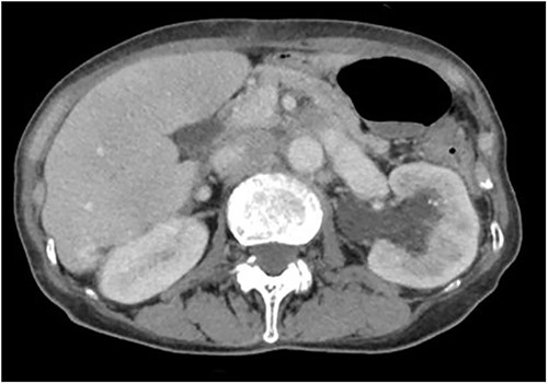 Abdominal CT scan; abdominal CT shows left hydronephrosis.