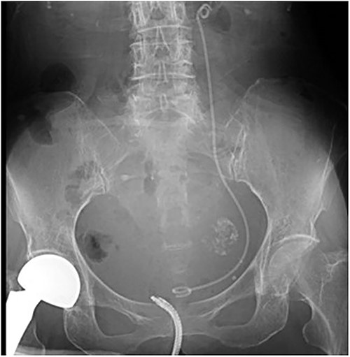 A post-operative plain abdominal X-ray; the ureteral stent is properly placed as seen in a plain abdominal X-ray.