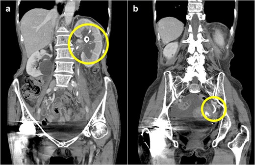 Abdominal CT scan; (a) CT demonstrates the position of proximal coil formation in the left renal pelvis; (b) CT demonstrates proximal stent migration into the ureter.