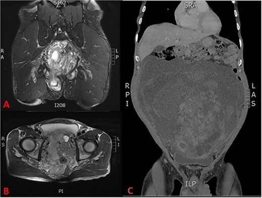 (A) T2 coronal section of MRI pelvis showing tumour invasion of the pelvic floor, (B) T2 axial MRI pelvis showing tumour involvement of the left seminal vesicle and, (C) coronal CT scan showing compression of the bladder and tumour burden.