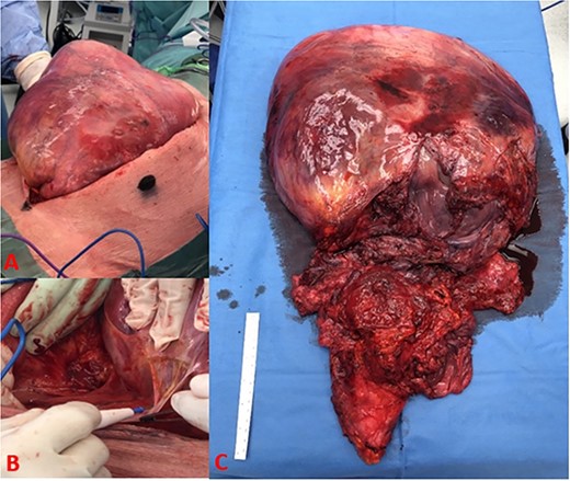 (A) Tumour burden on initial incision, (B) dense adhesive connection of tumour to retroperitoneal structures, and (C) complete excision of tumour with bladder, prostate, rectum, and seminal vesicle.