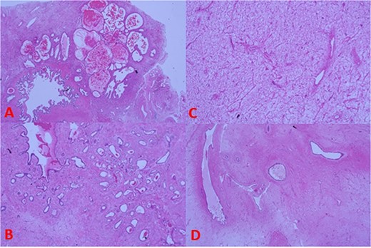 (A) Tumour histology next to seminal vesicle, (B) epithelial glandular component, (C) stromal component, and (D) phyllodes-like pattern on histology.