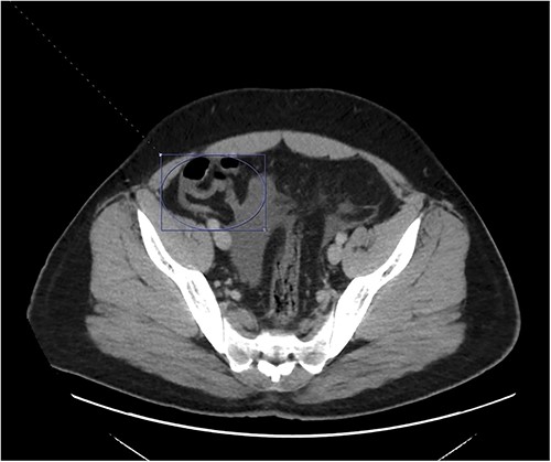 A hyperemic and inflamed appendix can be seen without an abscess, perforation, or appendicolith.