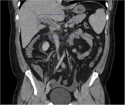 Thrombosis can be seen extending into the mesenteric venous system as well as the intrahepatic portal veins; associated mesenteritis and abdominal ascites (not well visualized) are also seen.