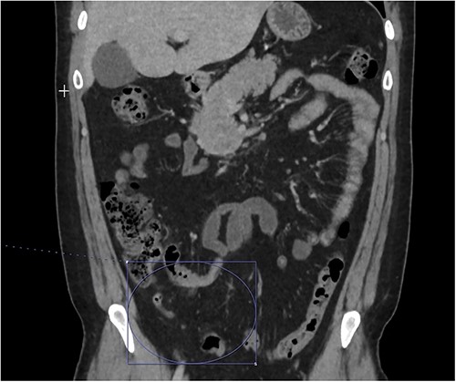 Interval decrease in inflammation surrounding the appendix.