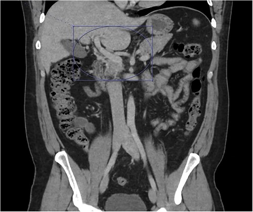Only a slender portion of thrombus remains in the main portal vein; the previously seen splenic vein thrombosis has largely resolved (not well visualized).