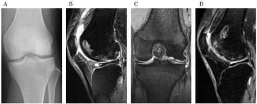Preoperative radiographs and MRI. (a) An anteroposterior radiograph of the left knee shows the flattened lateral femoral condyle and irregular lateral joint surface. (b) A sagittal fat saturation T2-weighted image and (c) a coronal T2-weighted image show large osteonecrosis of the left lateral femoral condyle and lateral discoid meniscal tear associated with cyst formation. (d) A sagittal fat saturation T2-weighted image of right knee (contralateral knee) shows osteonecrosis of the lateral condyle similar to the left knee.