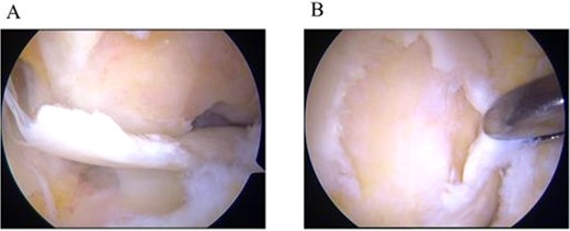 Arthroscopic findings. (a) Partially detached osteochondral fragment at the lateral femoral condyle. (b) Full-thickness cartilage defect after removal of the detached fragment.