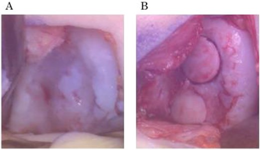 Intraoperative findings during OAT procedure. (a) Cartilage defect at the lateral condyle in the left knee. (b) Two osteochondral plugs transplanted into the recipient site.