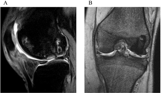 Two-year postoperative MRI. A sagittal fat saturation T2-weighted image (a) and a coronal T2-weighted image (b) show smooth articular surface in the grafted area and consolidation of the transplanted bone plugs.