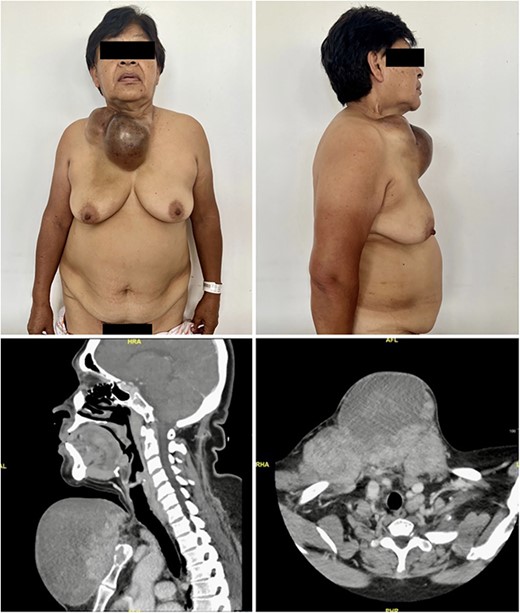 Preoperative photographs (upper, left and right) showing a large, hardened, bilobulated mass measuring 14 × 21 cm across the supraclavicular, infraclavicular, and presternal regions. The CT scans (lower, left and right) showing the posterior surface of the mass in contact with the pectoralis major muscle in the midline, the cortex of the sternal manubrium and the medial ends of both clavicles, and a poor interphase with the left sternocleidomastoid muscle at its caudal insertion.