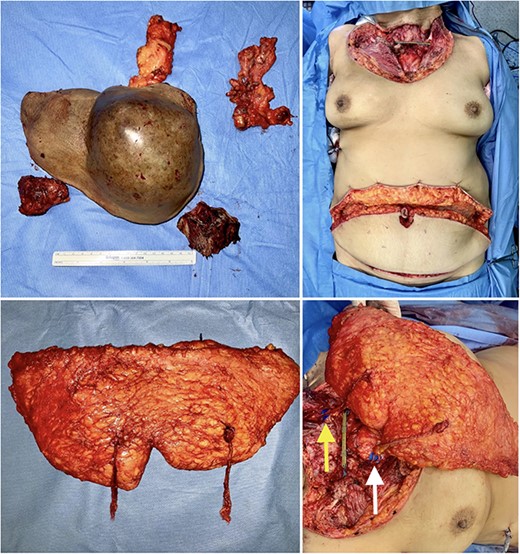 Intraoperative views of the specimens (upper, left), the surgical defect following resection measuring 16 × 27 cm (upper, right), the harvested bipedicled DIEP flap (lower, left), and after anastomoses to left transverse cervical vessels ( lower arrow) and right internal mammary vessels ( upper arrow) (lower, right).