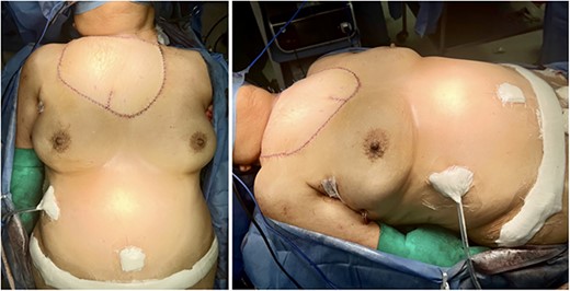 Immediate postoperative views depict sufficient coverage of the defect and satisfactory adaptation of the flap to the regional contour.
