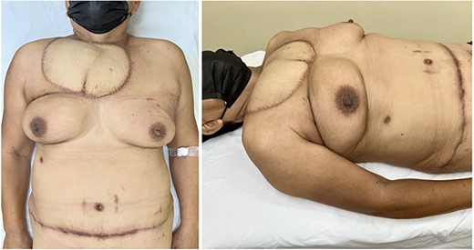 Appearance at 3-months postoperatively showcases a well-perfused flap with favorable scarring, and the absence of bulging or weakness in the abdominal wall at the donor site.