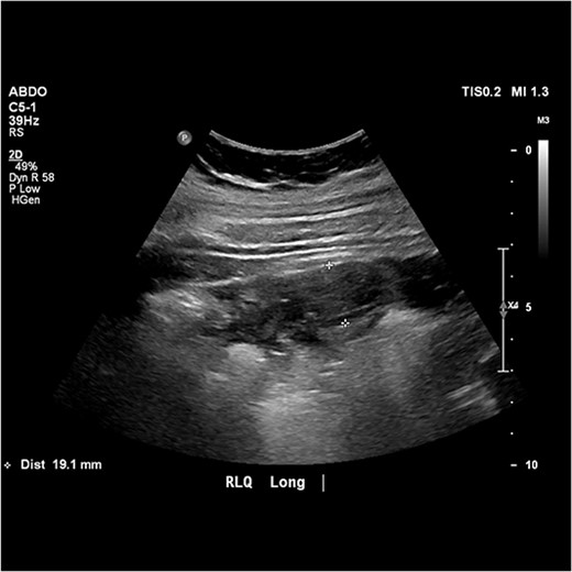 Image from abdominal ultrasound demonstrating hyperaemic, tubular structure measuring 19.1 mm in width with echogenic fat.