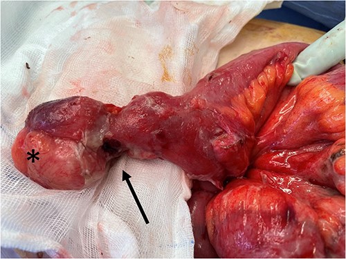 Intraoperative photo showing Meckel’s diverticulum with a mass (*) at the tip and adjacent proximal perforation proximal (black arrow).