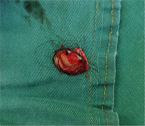 Gross specimens showed the mass as cystic, containing abundant hair.