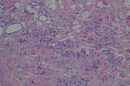 Histopathologic examination of the specimen showed inflamed granulation tissue with scattered foreign body giant cells (H&E; ×200).