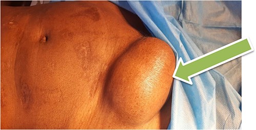 Femoral hernia in a 65-year-old female patient (arrow showing a bulky mass inferior to inguinal ligament with a normal overlying skin).