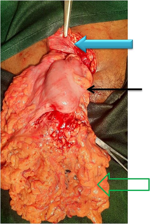 The content of the sac along with its contents (green open arrow shows viable omentum, black solid arrow shows transverse colon, and solid blue arrow shows an inguinal ligament).