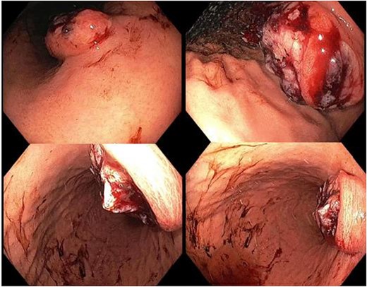 Upper gastrointestinal endoscopy showing a fungating, malignant appearing tumor along the gastric lesser curvature.
