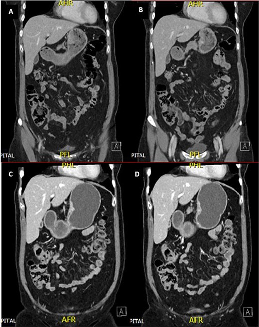 CT abdomen and pelvis demonstrated an enhancing nodular lesion along the gastric lesser curvature (A and B). Interval CT abdomen and pelvis showed reduced gastric wall thickening following 7 weeks of chemotherapy (C and D).