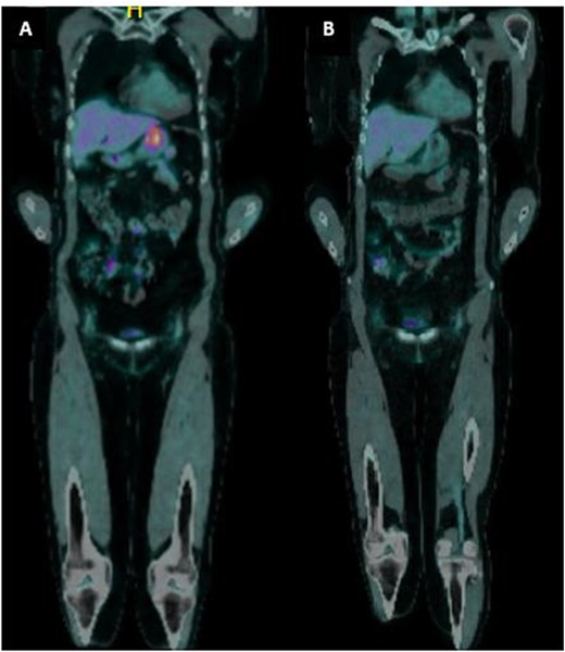 (a) PET imaging demonstrated intense FDG uptake along the lesser curvature of the stomach. (b) Interval PET imaging demonstrated reduced FDG uptake at the gastric lesser curvature and reduced gastric wall thickening.