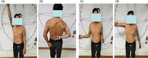 Preoperative functional comparison of both upper limbs: (a) lift of both upper limbs; (b) internal rotation of both upper limbs; (c) external rotation of both upper limbs; (d) abduction of both upper limbs.
