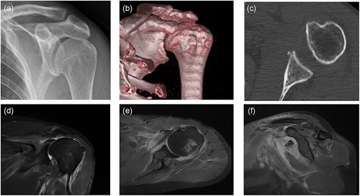 Preoperative imaging: (a) anteroposterior X-ray of the left shoulder; (b) anteroposterior CT 3D reconstruction of the left shoulder; (c) coronal CT radiograph of the left shoulder; (d) anteroposterior MRI of the left shoulder; (e) coronal MRI of the left shoulder; (f) sagittal MRI of the left shoulder.