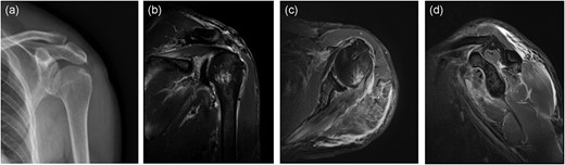 Postoperative imaging: (a) anteroposterior X-ray of the left shoulder; (b) anteroposterior MRI of the left shoulder; (c) coronal MRI of the left shoulder; (d) sagittal MRI of the left shoulder.