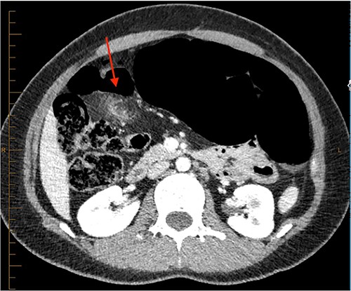 CT abdomen pelvis in 2019 (axial).