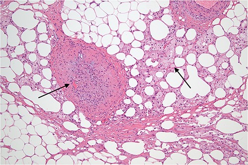 Slightly off-center nodule representing an obstructed medium sized blood vessel with fibrous occlusion of the lumen. There were several small vessels showing similar features in the biopsy indicating a chronic, possibly recurrent process. The necrosis demonstrated in the adjacent fatty tissue is not typical of mycobacterial infection and is what might follow ischemia, possibly related to omental volvulus or herniation and is indicative of a chronic process.