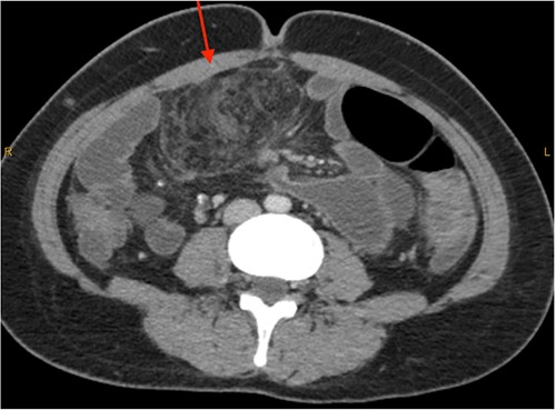 CT abdomen pelvis in 2023 (axial).